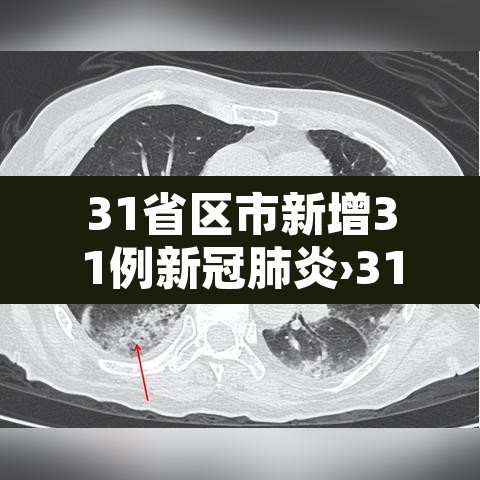 31省区市新增31例新冠肺炎›31省区市新增新冠肺炎确诊病例33例 31省区市新增31例新冠肺炎›31省区市新增新冠肺炎确诊病例33例